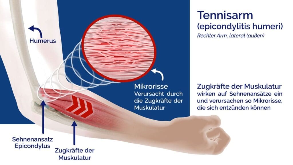 Masalo Manschette: Effektive Hilfe bei Tennisarm & Golferarm