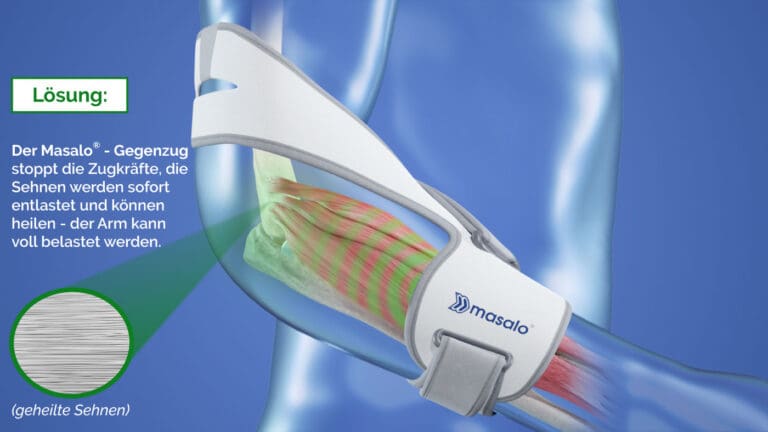 Masalo cuff: effectieve hulp voor tenniselleboog en golferselleboog